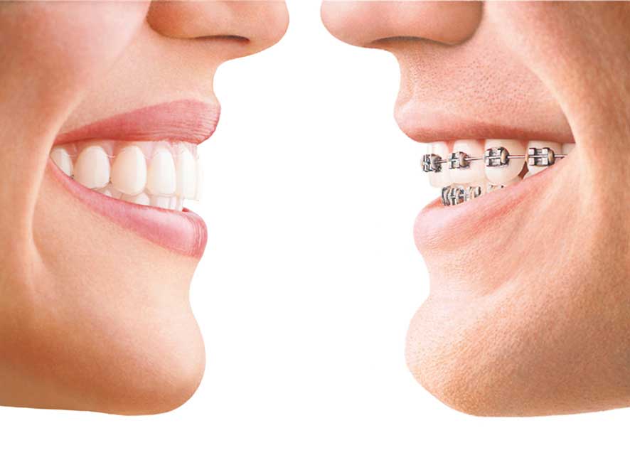 Braces vs. Invisalign, Sword Orthodontics